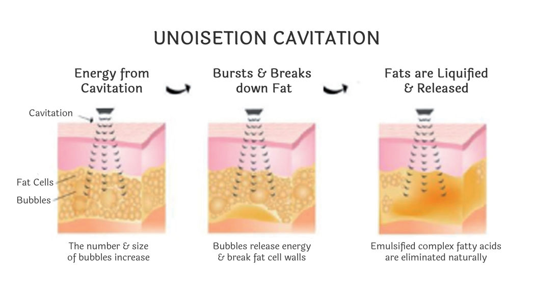 Ultrasonic Cavitation 40