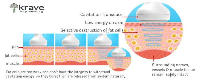 Non-invasive contouring option - Krave Body Contouring Peoria Arizona